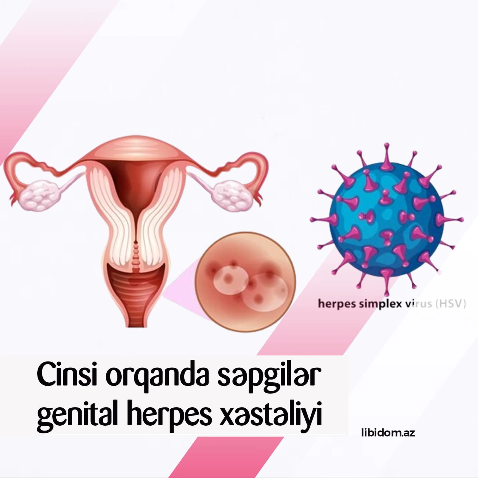 Genital herpes xəstəliyi